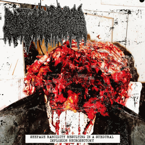 Cystic Hygroma : Seepage Rancidity Resulting in a Subdural Implosion Necrosectomy